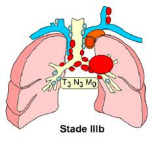 Thyroid nodule ICD 9